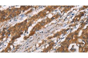 Immunohistochemistry of paraffin-embedded Human gasrtic cancer tissue using DSC2 Polyclonal Antibody at dilution 1:35 (Desmocollin 2 antibody)