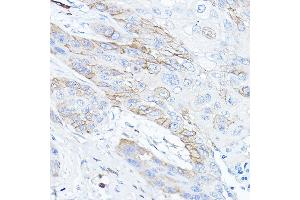 Immunohistochemistry of paraffin-embedded human esophageal cancer using TMPRSS2 Rabbit pAb (ABIN6132728, ABIN6149286, ABIN6149287 and ABIN6219138) at dilution of 1:50 (40x lens).
