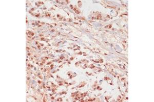 Immunohistochemistry of paraffin-embedded human gastric cancer using Phospho-PPP1CA-T320 antibody (ABIN7269674) at dilution of 1:100 (40x lens). (PPP1CA antibody  (pThr320))
