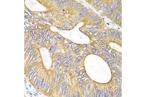 Immunohistochemistry of paraffin-embedded human colon carcinoma using VEGFB antibody at dilution of 1:100 (400x lens).