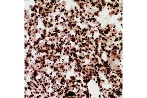 Immunohistochemical analysis of ZNF600 staining in human lung cancer formalin fixed paraffin embedded tissue section. (ZNF600 antibody)