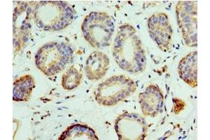 Immunohistochemistry of paraffin-embedded human breast cancer using ABIN7151101 at dilution of 1:100 (Pellino 1 antibody  (AA 1-250))