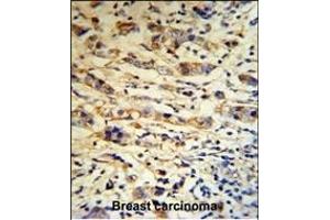 A1BG Antibody (C-term) (R) IHC analysis in formalin fixed and paraffin embedded human breast carcinoma tissue followed by peroxidase conjugation of the secondary antibody and DAB staining. (A1BG antibody  (C-Term))