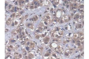 DAB staining on IHC-P; Samples: Human Breast cancer Tissue (CPEB1 antibody  (AA 311-561))