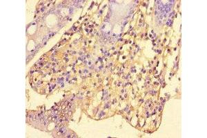 Immunohistochemistry of paraffin-embedded human colon cancer using ABIN7169823 at dilution of 1:100 (SLIT-ROBO rho GTPase Activating Protein 2C (SRGAP2C) (AA 1-242) antibody)