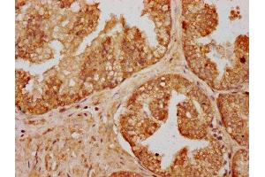 IHC image of ABIN7166823 diluted at 1:200 and staining in paraffin-embedded human prostate cancer performed on a Leica BondTM system. (C14ORF177 antibody  (AA 1-125))