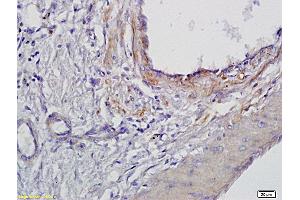 Formalin-fixed and paraffin embedded human gastric cancer labeled with Anti BMAL1 Polyclonal Antibody, Unconjugated (ABIN703571) at 1:300 followed by conjugation to the secondary antibody and DAB staining (ARNTL antibody  (AA 151-250))
