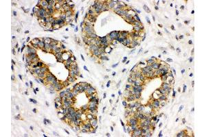 Anti- ITGA2B Picoband antibody, IHC(P) IHC(P): Human Mammary Cancer Tissue (Integrin Alpha2b antibody  (C-Term))