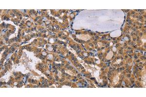 Immunohistochemistry of paraffin-embedded Human thyroid cancer tissue using EPHB6 Polyclonal Antibody at dilution 1:50 (EPH Receptor B6 antibody)