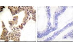 Immunohistochemistry analysis of paraffin-embedded human lung carcinoma, using Caspase 2 (Phospho-Ser157) Antibody.