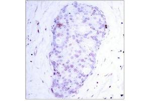 Immunohistochemical analysis of paraffin-embedded human breast carcinoma tissue using NF-κ,B p105(phospho-Ser907) antibody. (NFKB1 antibody  (pSer907))