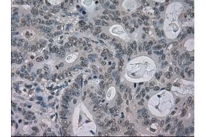 Immunohistochemical staining of paraffin-embedded Carcinoma of liver tissue using anti-BUB1Bmouse monoclonal antibody. (BUB1B antibody)