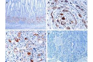 Immunohistochemical analysis of EPHB1 in human gastric cancer tissues. (EPH Receptor B1 antibody  (C-Term))