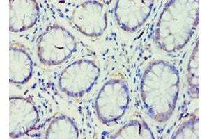 Immunohistochemistry of paraffin-embedded human colon cancer using ABIN7167947 at dilution of 1:100 (GRAF antibody  (AA 625-814))