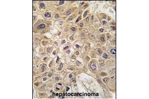 Immunohistochemistry (Paraffin-embedded Sections) (IHC (p)) image for anti-Autocrine Motility Factor Receptor (AMFR) (AA 571-601) antibody (ABIN388938)