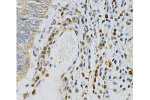Immunohistochemistry of paraffin-embedded Human colon carcinoma using CDA Polyclonal Antibody at dilution of 1:100 (40x lens).