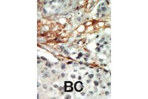 Formalin-fixed and paraffin-embedded human cancer tissue reacted with PRKAB2 polyclonal antibody  , which was peroxidase-conjugated to the secondary antibody, followed by AEC staining . (PRKAB2 antibody  (N-Term))
