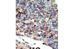 Formalin-fixed and paraffin-embedded human cancer tissue reacted with the primary antibody, which was peroxidase-conjugated to the secondary antibody, followed by AEC staining. (PI3KC2G antibody  (N-Term))