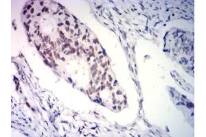 Immunohistochemical analysis of paraffin-embedded rectal cancer tissues using PGR mouse mAb with DAB staining. (Progesterone Receptor antibody  (AA 166-411))
