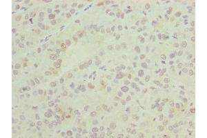 Immunohistochemistry of paraffin-embedded human liver cancer using ABIN7144721 at dilution of 1:100 (ASNSD1 antibody  (AA 258-357))