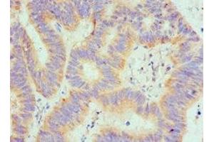 Immunohistochemistry of paraffin-embedded human colon cancer using ABIN7168895 at dilution of 1:100 (SPTLC1 antibody  (AA 37-310))