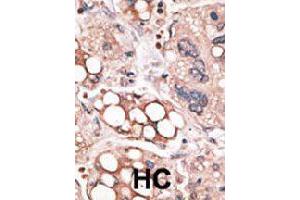 Formalin-fixed and paraffin-embedded human hepatocellular carcinoma tissue reacted with FOXO4 polyclonal antibody  , which was peroxidase-conjugated to the secondary antibody, followed by AEC staining. (FOXO4 antibody  (N-Term))