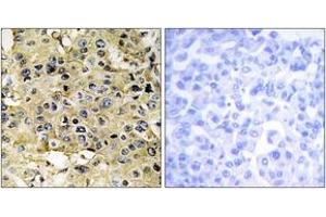 Immunohistochemistry analysis of paraffin-embedded human breast carcinoma tissue, using ENTK Antibody. (TMPRSS15 antibody  (AA 81-130))