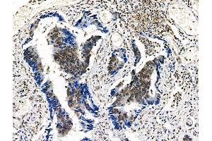Phospho-n-Myc (Ser261/Ser263) Antibody at 1/100 staining Human colorectal cancer by IHC-P.