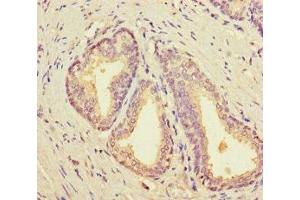 Immunohistochemistry of paraffin-embedded human prostate cancer using ABIN7161699 at dilution of 1:100 (SCP2 antibody  (AA 1-143))