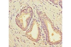 Immunohistochemistry of paraffin-embedded human prostate cancer using ABIN7161699 at dilution of 1:100