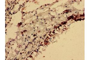 Immunohistochemistry analysis of human lung cancer using ABIN7153105 at dilution of 1:100 (FOXR2 antibody  (AA 1-300))
