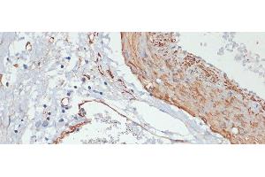 Immunohistochemistry of paraffin-embedded Human gastric cancer using Phospho-MYL9(T18/S19) Polyclonal Antibody at dilution of 1:100 (40x lens). (MYL9 antibody  (pSer19, pThr18))