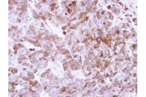 IHC-P Image Immunohistochemical analysis of paraffin-embedded H520 xenograft, using Factor XIIIa, antibody at 1:500 dilution. (F13A1 antibody  (N-Term))