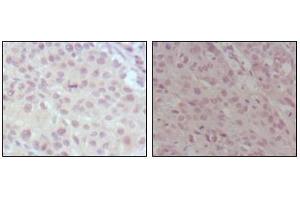 Immunohistochemical analysis of paraffin-embedded human lung cancer (left) and esophagus cancer (right), showing nuclear weak staining with DAB staining using MLL mouse mAb. (MLL/KMT2A antibody  (AA 3751-3968))