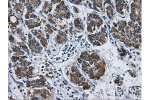 Immunohistochemical staining of paraffin-embedded Carcinoma of liver tissue using anti-ATP5B mouse monoclonal antibody.