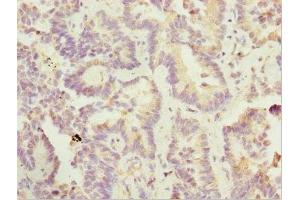 Immunohistochemistry of paraffin-embedded human lung cancer using ABIN7169185 at dilution of 1:100 (SIK3 antibody  (AA 60-310))