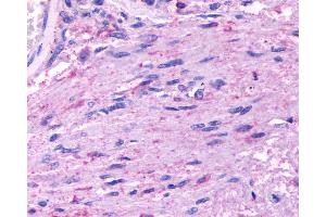 Anti-HTR5A / 5-HT5A Receptor antibody IHC of human Brain, Glioblastoma. (Serotonin Receptor 5A antibody  (Cytoplasmic Domain))