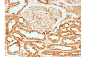 IHC testing of FFPE human renal cell carcinoma with Calnexin antibody.