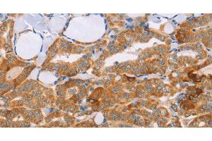 Immunohistochemistry of paraffin-embedded Human thyroid cancer tissue using CARD6 Polyclonal Antibody at dilution 1:60 (CARD6 antibody)