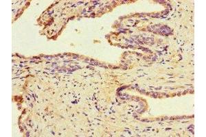 Immunohistochemistry of paraffin-embedded human prostate cancer using ABIN7159790 at dilution of 1:100 (MAST1 antibody  (AA 687-879))