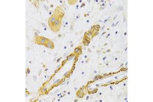Immunohistochemistry of paraffin-embedded human liver cancer using KIF1B Antibody (ABIN2563552) at dilution of 1:100 (40x lens). (KIF1B antibody)