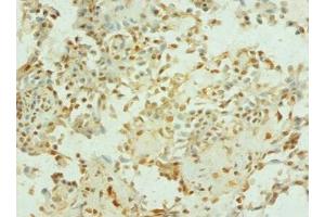 Immunohistochemistry of paraffin-embedded human breast cancer using  at dilution of 1: 100