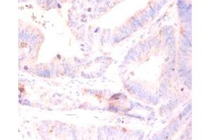 Immunohistochemistry of paraffin-embedded human colon cancer using ABIN7142829 at diluton of 1:50 (RPL5 antibody  (AA 2-297))