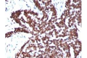 Formalin-fixed, paraffin-embedded human ovarian carcinoma stained with Cyclin B1 antibody. (Cyclin B1 antibody)