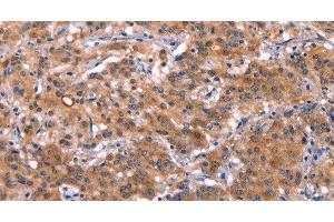 Immunohistochemistry of paraffin-embedded Human gastic cancer using HMGCS1 Polyclonal Antibody at dilution of 1:40 (HMGCS1 antibody)