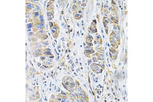 Immunohistochemistry of paraffin-embedded human liver cancer using VAPB Antibody (ABIN1876551) at dilution of 1:200 (40x lens). (VAPB antibody)