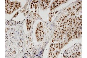 Immunoperoxidase of monoclonal antibody to PBK on formalin-fixed paraffin-embedded human cholangiocarcinoma. (PBK antibody  (AA 1-30))