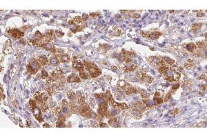 ABIN6279753 at 1/100 staining Human liver cancer tissue by IHC-P. (PTPRK antibody  (Internal Region))