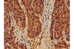 Immunohistochemistry of paraffin-embedded human ovarian cancer using ABIN7151428 at dilution of 1:100 (EFHD2 antibody  (AA 2-240))