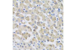 Immunohistochemistry of paraffin-embedded human liver injury using SNAP29 antibody at dilution of 1:100 (x40 lens).